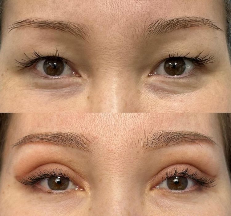 -50% CHEGIRMADA Blefaroplastika