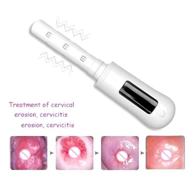 360° Гинекологично Неинвазивна Лазерна Терапия за Влагалищно Затягане