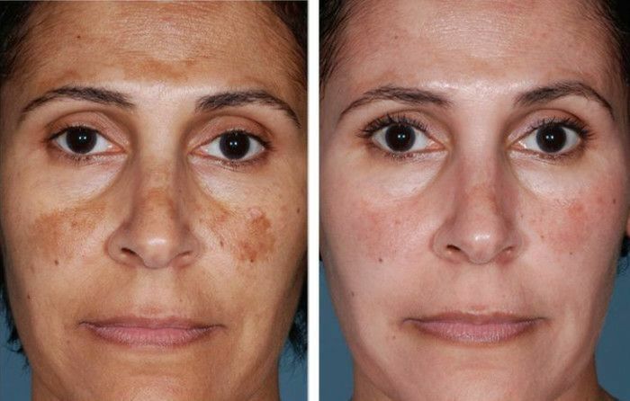 Улитки радация стандарт 4-5см