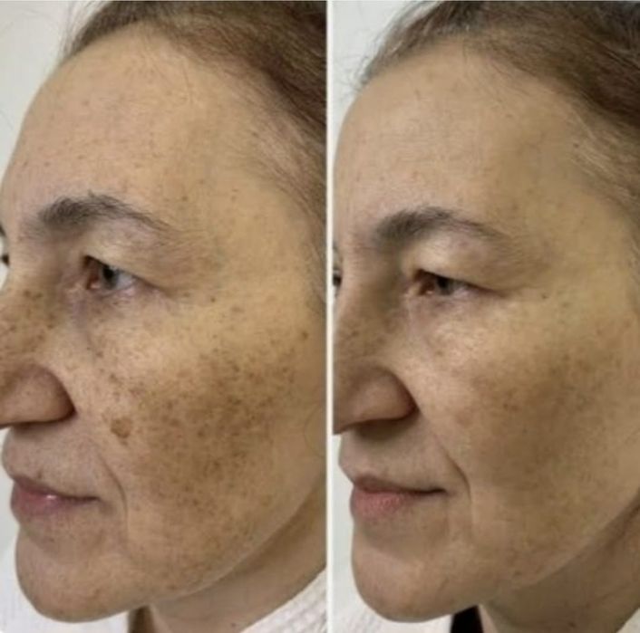 *Kosmetolog hizmatlari. Yuzdagi doglarni ketkazish