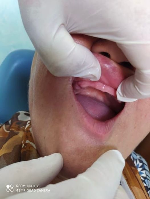 Сьемные зубные протезы быстро и качественно