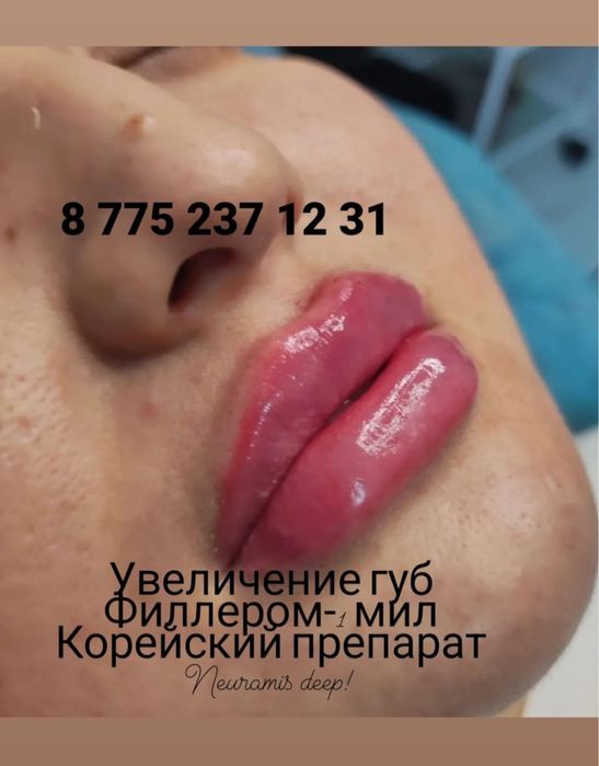 Увеличение губ филлером