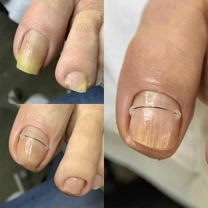 Afectiuni Unghii si Talpi - Podologie doar cu asistenti medicali