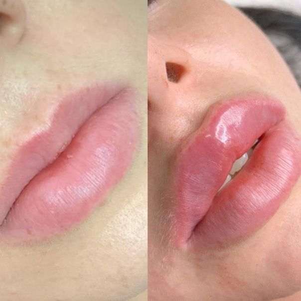 Увеличение губ. Филлер юж. Корея. СКИДКИ