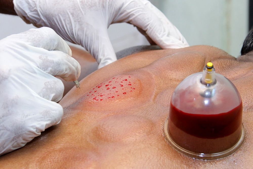 Хиджама в Каскелене