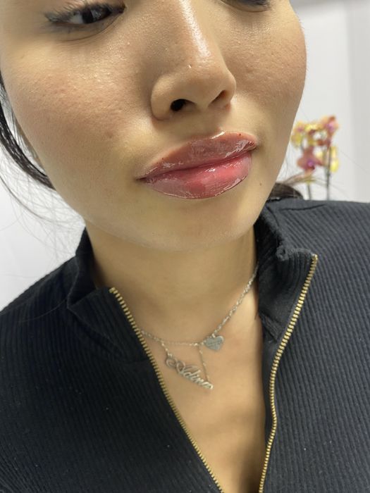 Акция Увеличение Губ