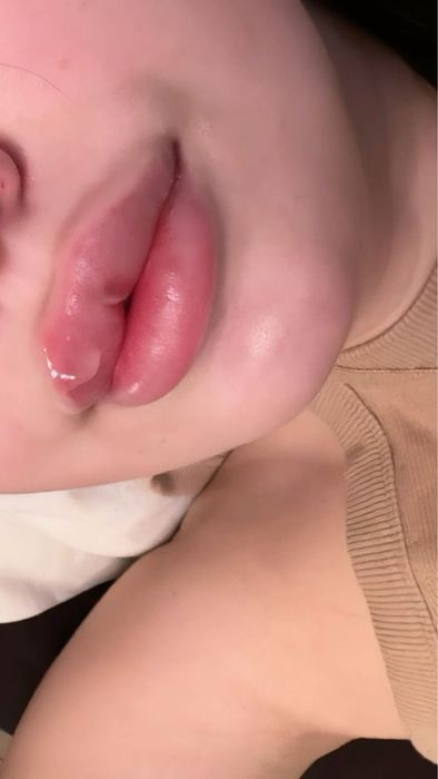 Лабга филлер дахан чикариш насагубка мезаботех