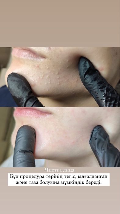 Чистка лица с результатом с первой процедуры