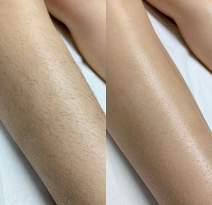 Шугаринг всего тела