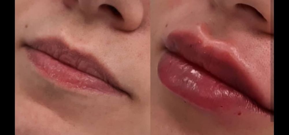 Гипергидроз.Губы.Похудение.Ботокс.Пирсинг.Морщины.Молодильное яблочко