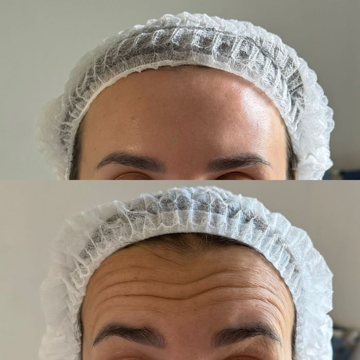 КОСМЕТОЛОГ скидка ботокс филлер нити мезотерапия