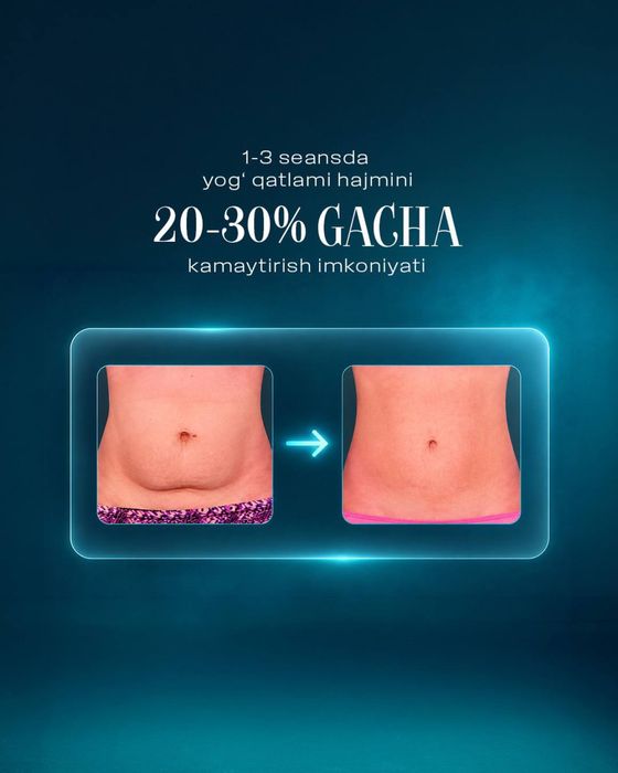 Криолиполиз аппарат