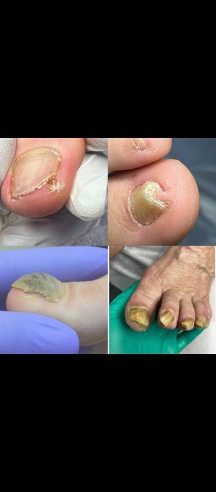 Курс на подолога, работа с проблемными ногтями