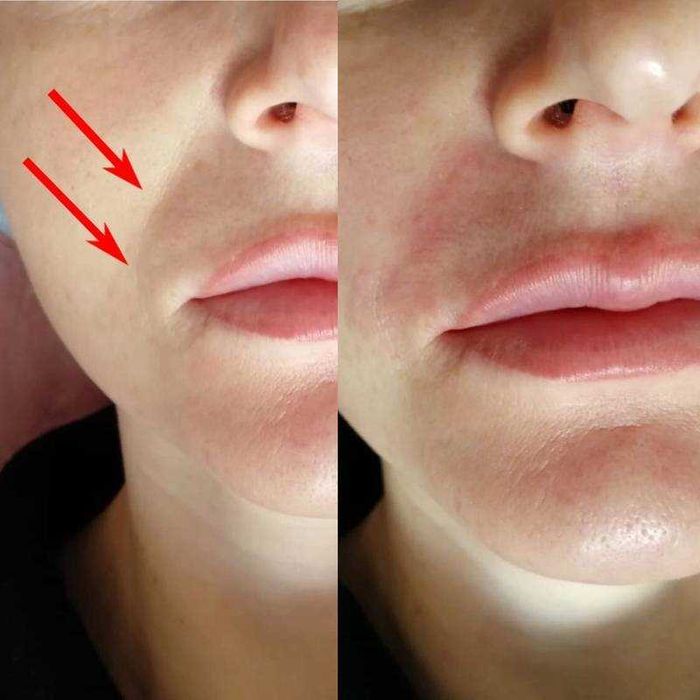 Коррекция носогубных складок филлерами в Ташкенте