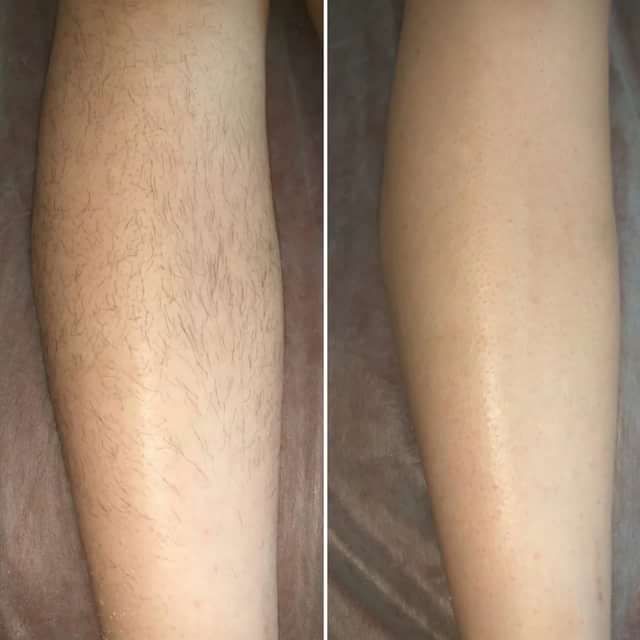 Шугаринг|воск | Депиляция