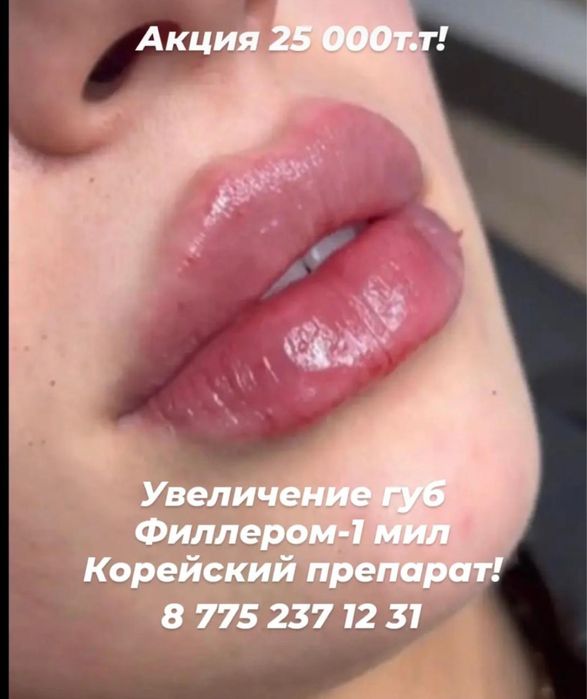 Увеличение губ филлером