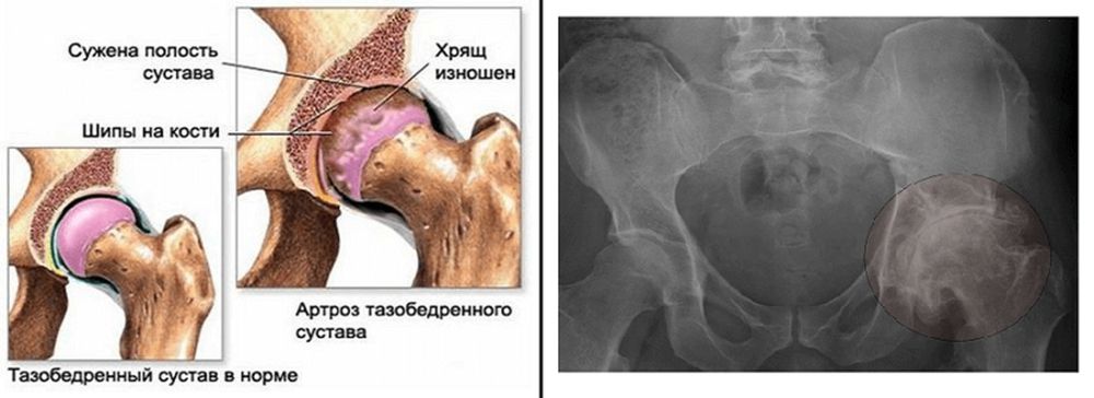 Коксартроз - не приговор