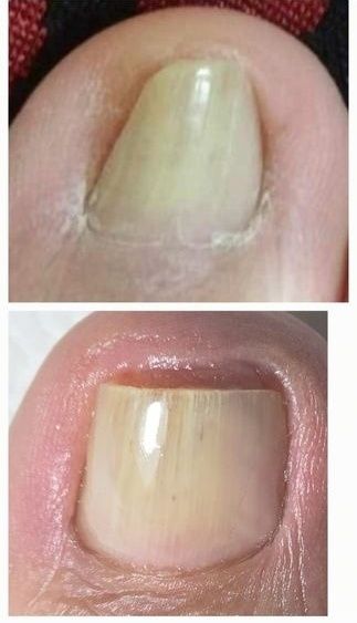 Cabinet pedichiura complexa /onicomicoze /unghii încarnate Alb