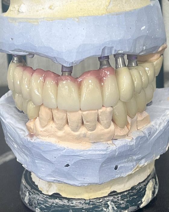 Цирконий / E-max за 2–3 дня | Luminora Dental