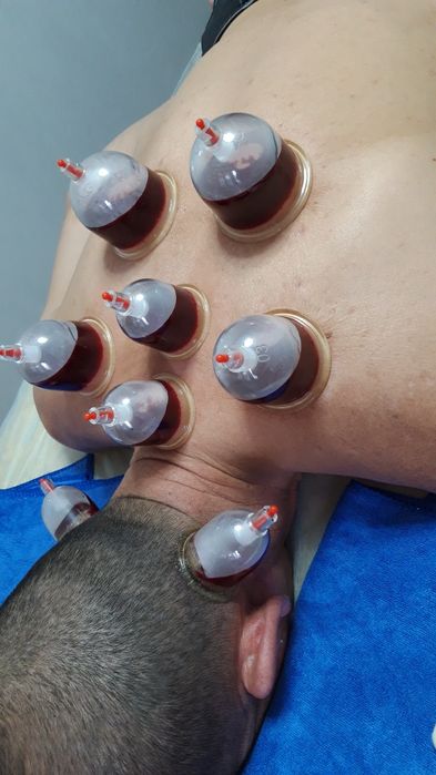 Хиджама. Шертпе. Пиявки