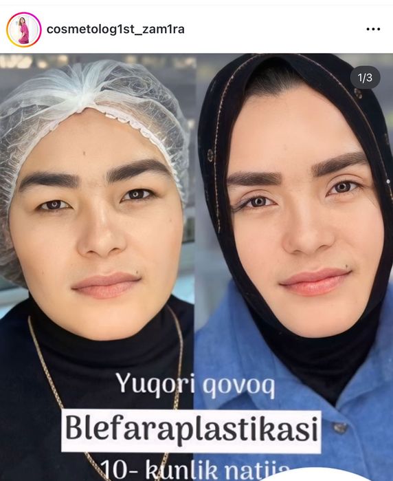 Лабга филлер ботекс