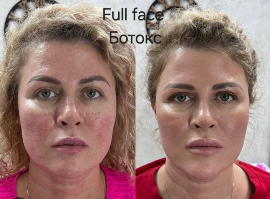 Ботокс. Лоб, межбровка,глаза.  Шея, овал лица