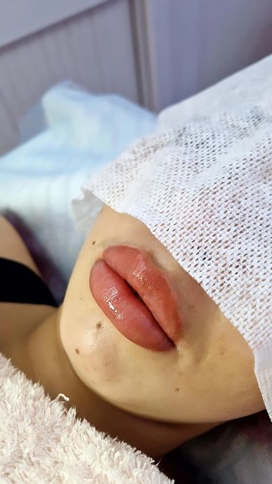 Увеличение губ Косметолог