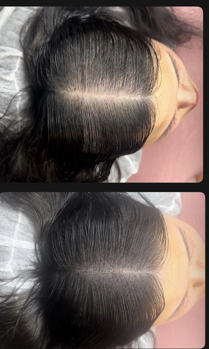 Micropigmentare scalp si barba indesire par tatuaj alopecie chelie