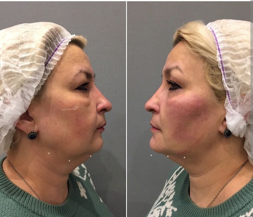 Безоперационная подтяжка лица 40 тысяч тг