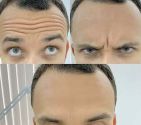 Ботокс,Траптокс,Гипергидроз.Botoks, Traptoks, Qùltiq terlash, gipergid