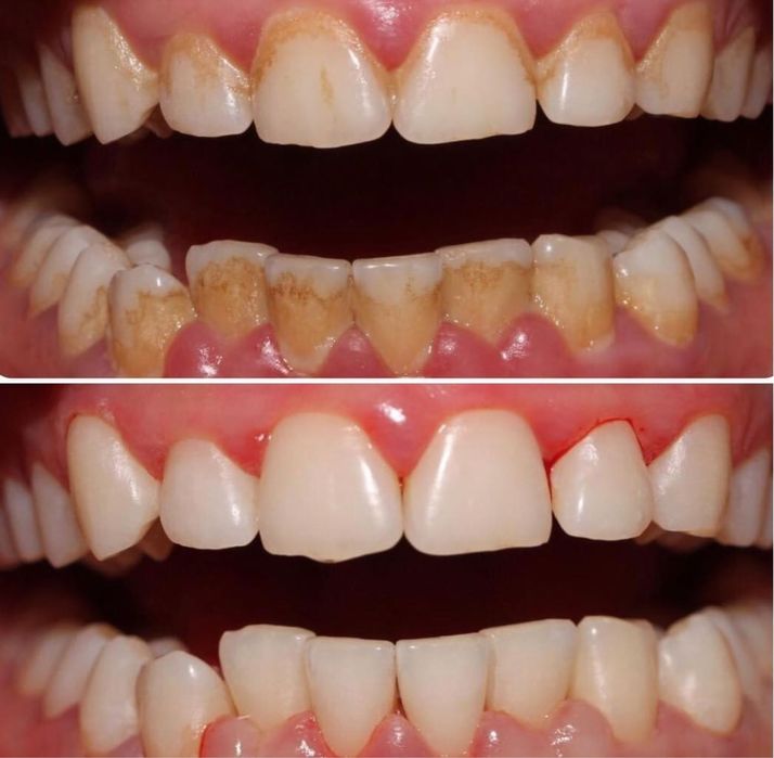 Профессиональная чистка зубов(200тсум)