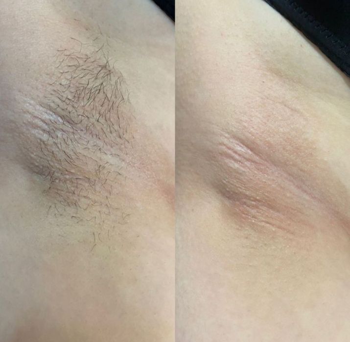 Шугаринг всего тела