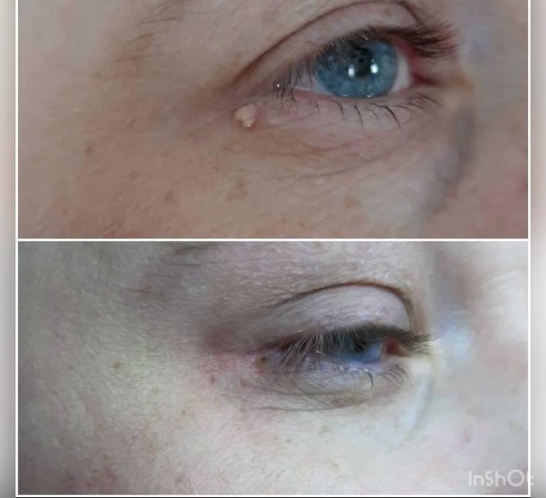 Косметолог Костанай удаление папиллом и бородавок