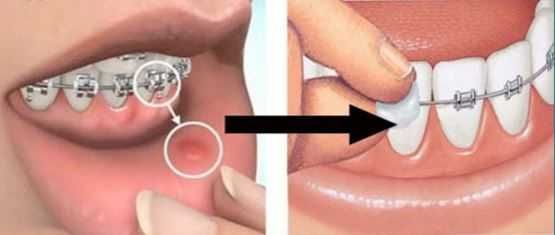 Воск для брекетов