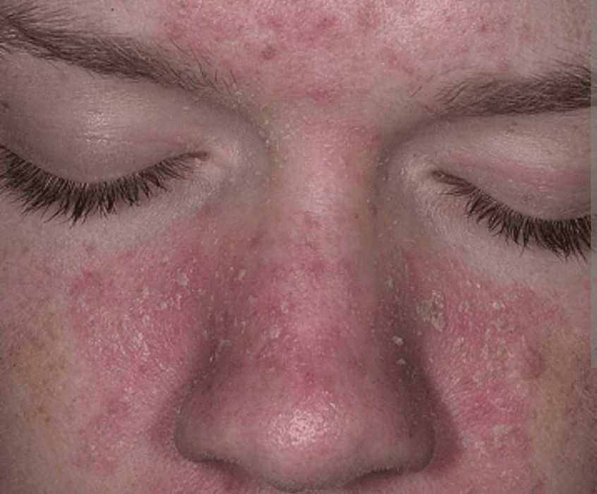 Себореен дерматит , себорея , крем , лечение , терапия , пъпки