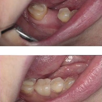 Протез зубной техник