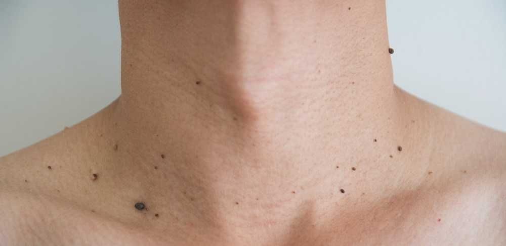 Лазерное удаление папиллом и бородавок на дому, в клинике коагулятором