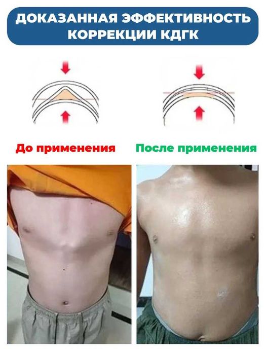 Ортез при килевидной деформации грудной клетки