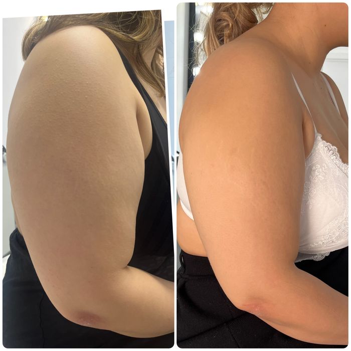 Ультраформер, косметологический аппарат