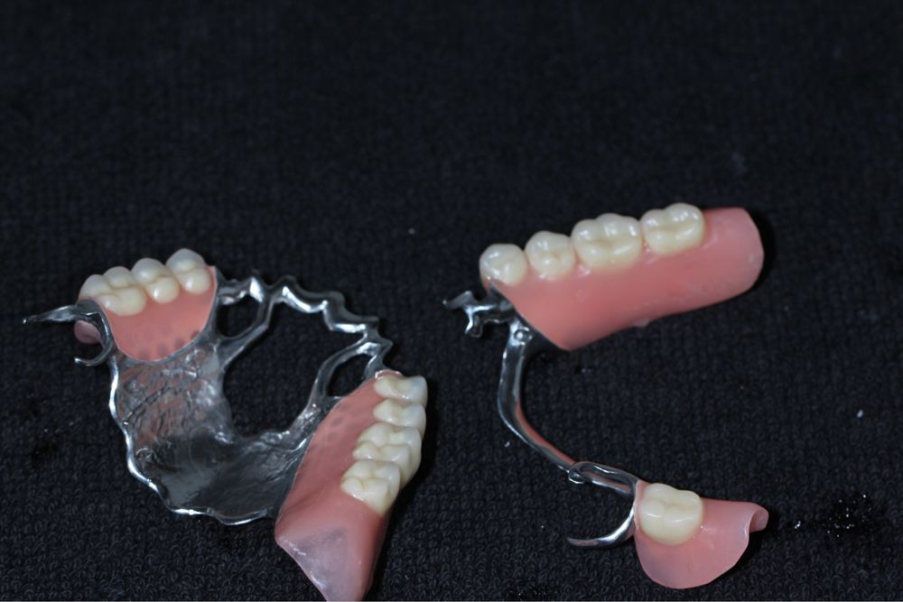 Бюгельные протезы отзывы фото Бюгельные протезы отзывы фото