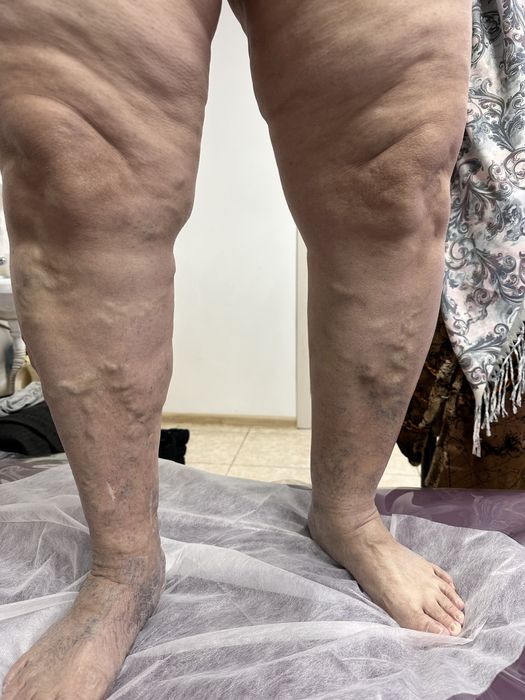 УЗИ (Уздг) сосудов