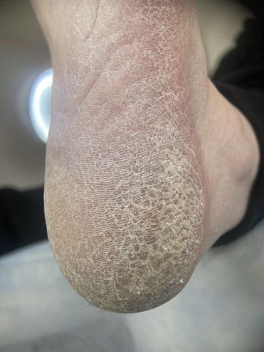 Подолог.Бородавки.Вросший ноготь