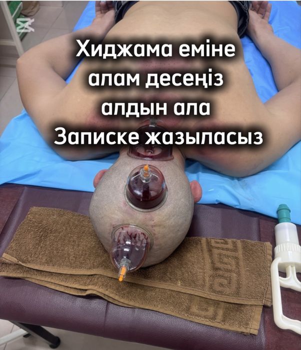 Хиджама, Пиявки Массаж емдері