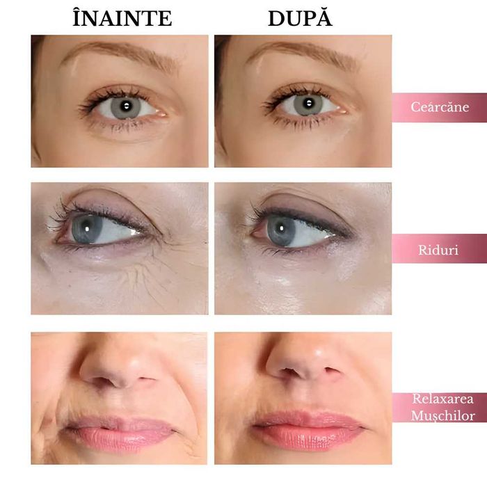 Dispozitiv Premium Reglabil, pentru Aplicarea Acidului Hialuronic