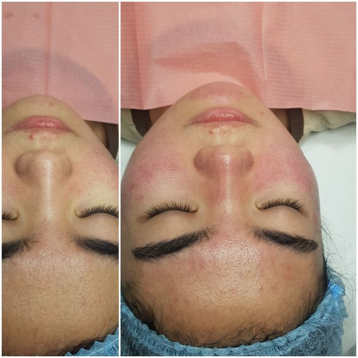 Косметолог.  Чистка лица