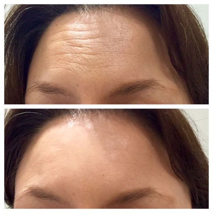 Естественное омоложение холодной плазмой