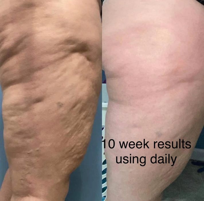 Ageloc Dermatic Effects - crema impotriva celulitei si a vergeturilor