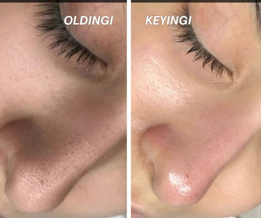 *Kosmetolog hizmatlari. Yuzdagi doglarni ketkazish