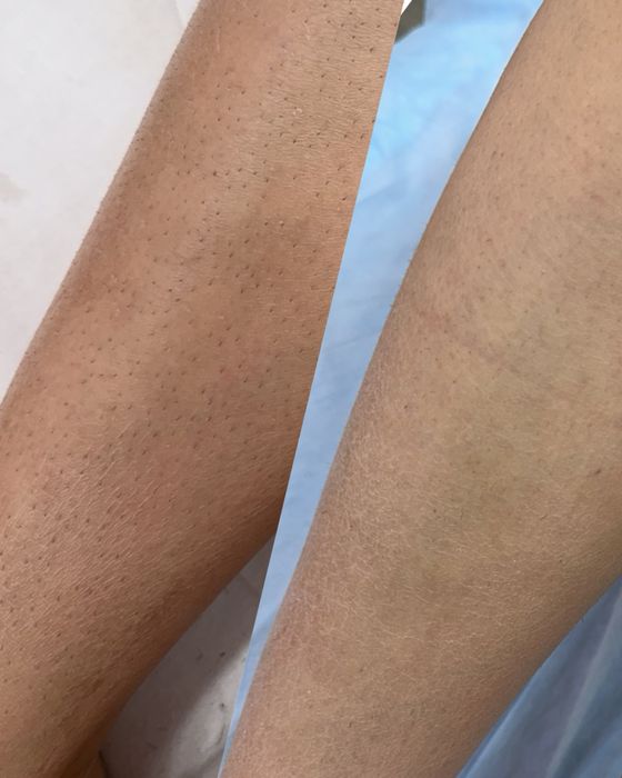 Лазерный аппарат сопрано титанум