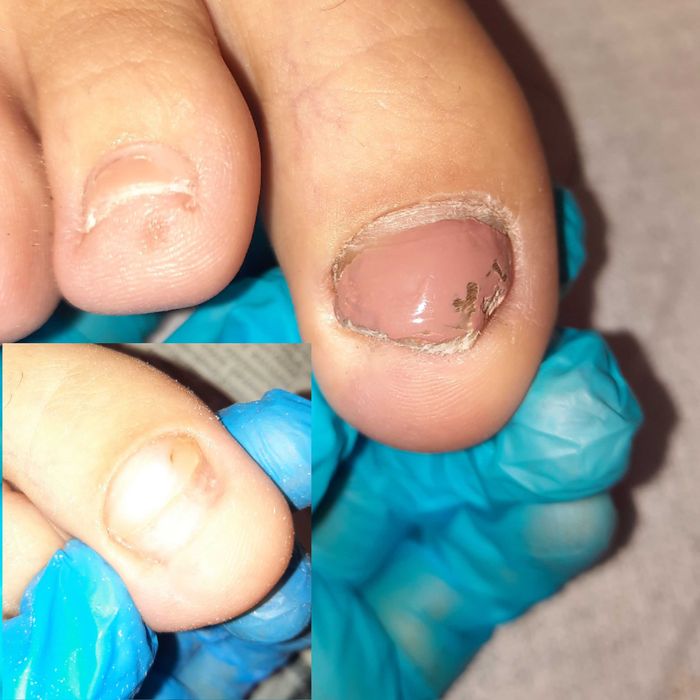 удаление вросшего ногтя